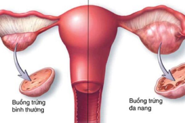 Hội chứng buồng trứng đa nang (PCOS)