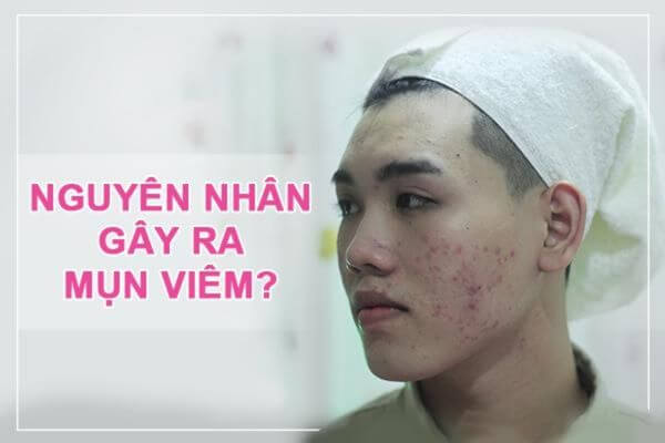  Nguyên nhân gây ra mụn viêm