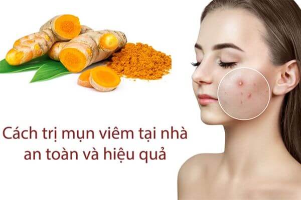  Trị mụn viêm bằng mẹo tự nhiên ngay tại nhà